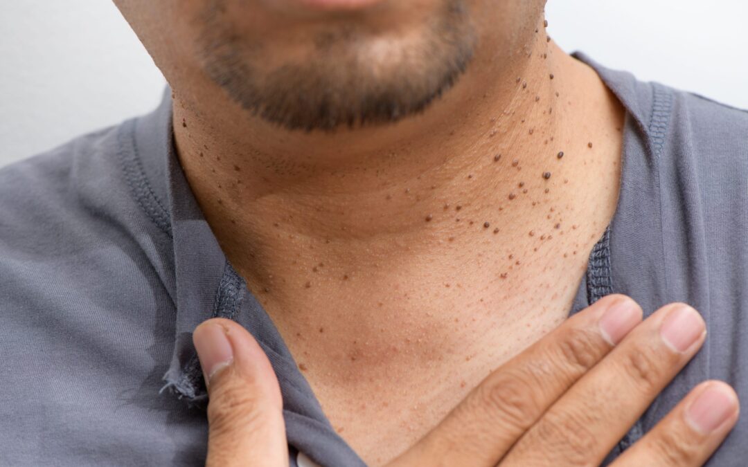 Verrugas en el cuello y axilas: ¿por qué aparecen y cómo eliminarlas?